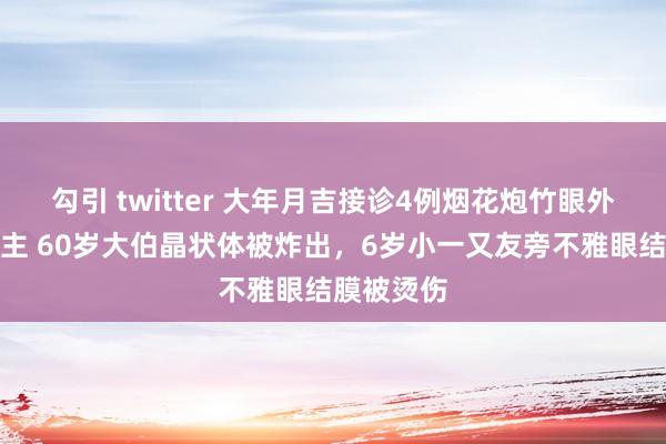 勾引 twitter 大年月吉接诊4例烟花炮竹眼外伤病东谈主 60岁大伯晶状体被炸出，6岁小一又友旁不雅眼结膜被烫伤